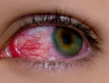 Ραγοειδίτιδα: Αίτια και συμπτώματα της πιο άγνωστης ασθένειας των ματιών